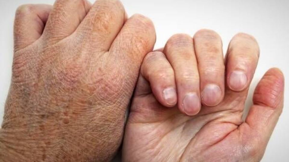 شناسایی بیش از ۱۱ هزار بیمار  مبتلا به جذام در کشور